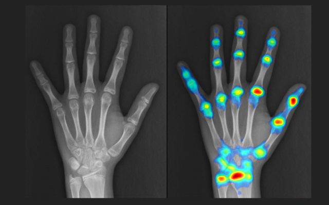 Hand-XRAY